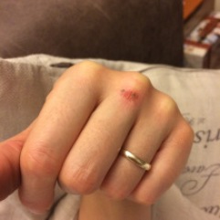 Occupational hazards of boxing